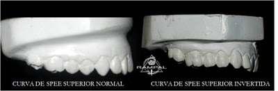 Fig. 2.1. Curva de spee invertida en el arco superior es por una sobreerupcion de las coronas de los incisivos superiores,caso clínico del Dr. Pablo Ramos pramos@ortodoncia.
