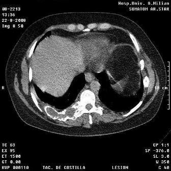 Dados los hallazgos encontrados en el Rx de tórax se le realizó, posteriormente, una tomografía axial computadorizada (TAC) de pulmón con reconstrucciones en 3D (figuras 2 y 3) en la que se observó