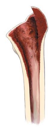 La estabilidad inicial se consigue por aposición íntima del hueso /prótesis.