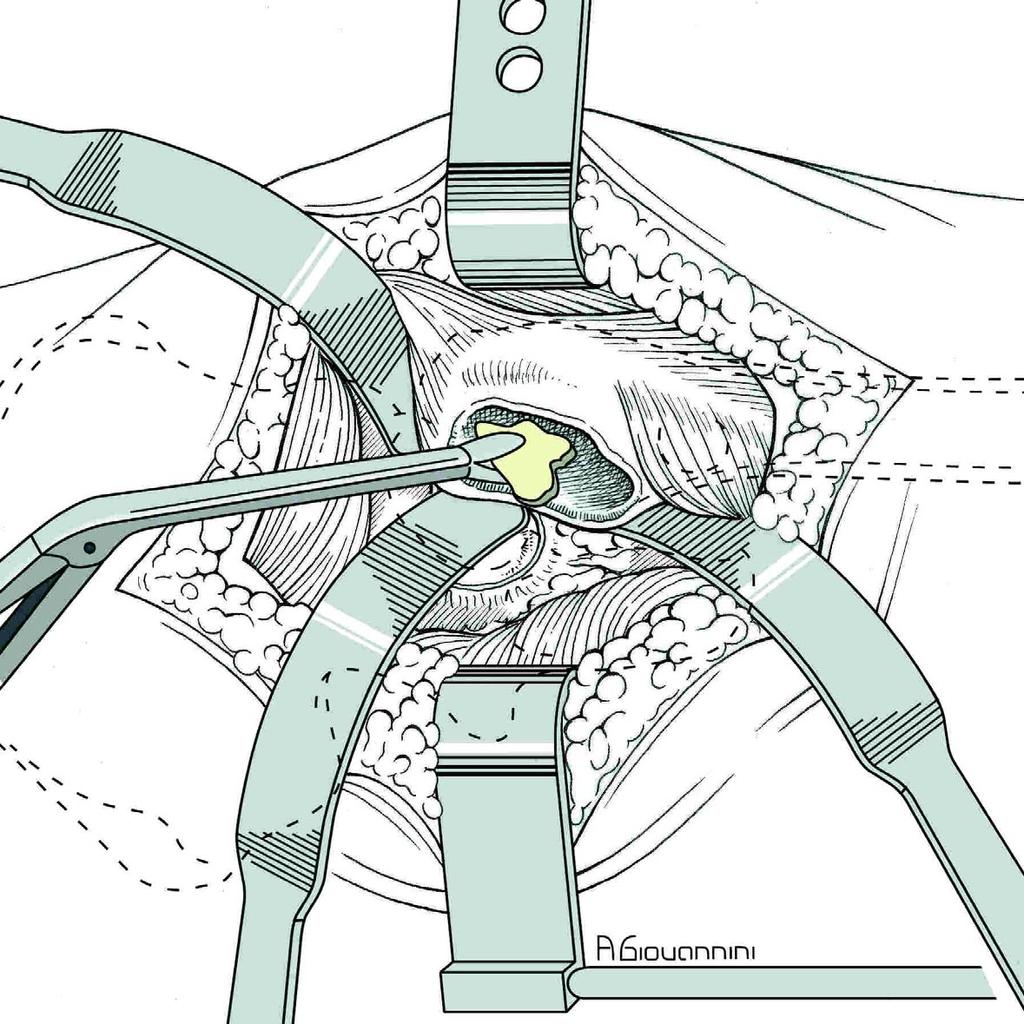 En caso de prótesis fija modular, despegar el glúteo menor de la cara lateral del ilion para poder alojar en este plano el cuello femoral sin la cabeza.(batiportar el cuello).