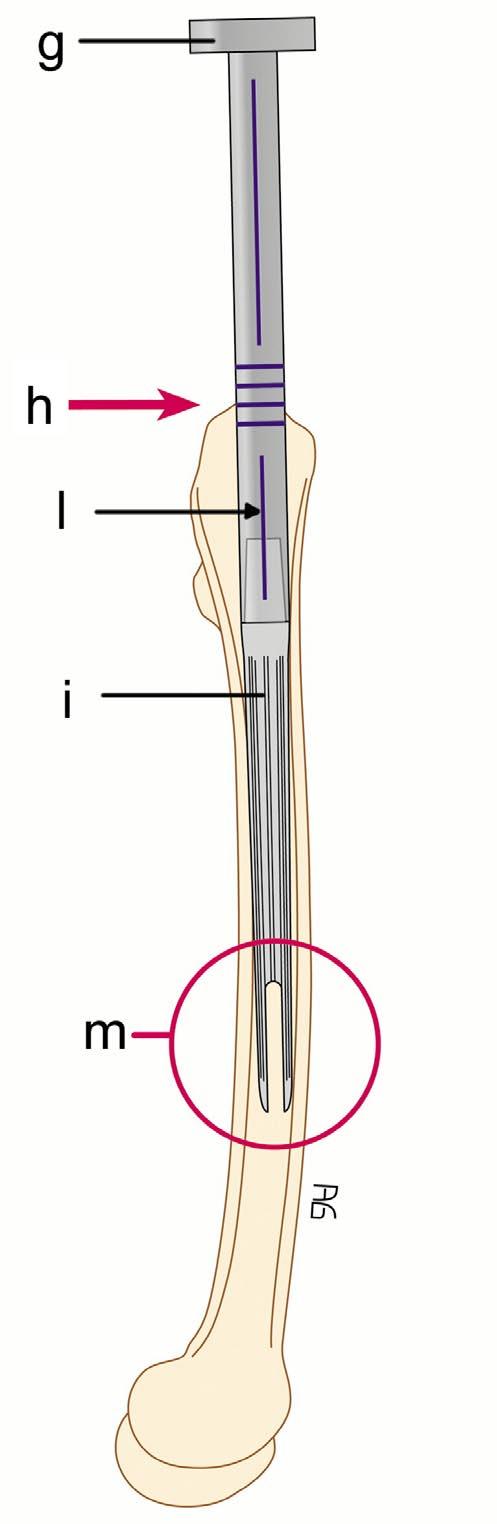 11B Tras haber preparado el canal diafisario y el alojamiento metafisario de la nueva prótesis MGS se implanta el tallo distal.