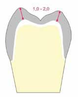 Corona de diente lateral Es imprescindible diseñar de forma anatómica la estructura de óxido de circonio, reforzando sobre todo las cúspides.