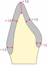 Corona individual de diente anterior Incisal > 1,4 mm Labial o bien oral en el tercio superior > 1,4 mm Zona del borde, circular aprox.
