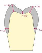 Corona individual de diente lateral Oclusal > 1,4 mm Labial o bien oral en el tercio superior > 1,4 mm Zona del borde, circular aprox.