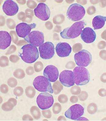 2 Datos de expresión genética. Figura 2.15: Muestra de la médula de un paciente con leucemia linfoide aguda (Fuente Wikimedia http://commons.wikimedia.org/wiki/file:acute leukemia-all.jpg).
