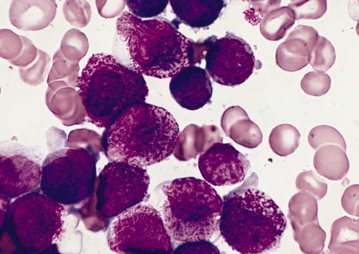 Datos de expresión genética y redes bayesianas. 2.5 Figura 2.16: Muestra de la médula de un paciente con leucemia mieloide aguda (Fuente Wikimedia http://commons.wikimedia.org/wiki/file:aml-m3.jpg).