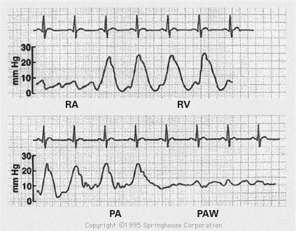 Figura 1: Curvas de presión y su relación con ECG RA= Aurícula Derecha, RV= Ventrículo Derecho, PA= Arteria Pulmonar, PAW= Enclavamiento Lecturas recomendadas 1.