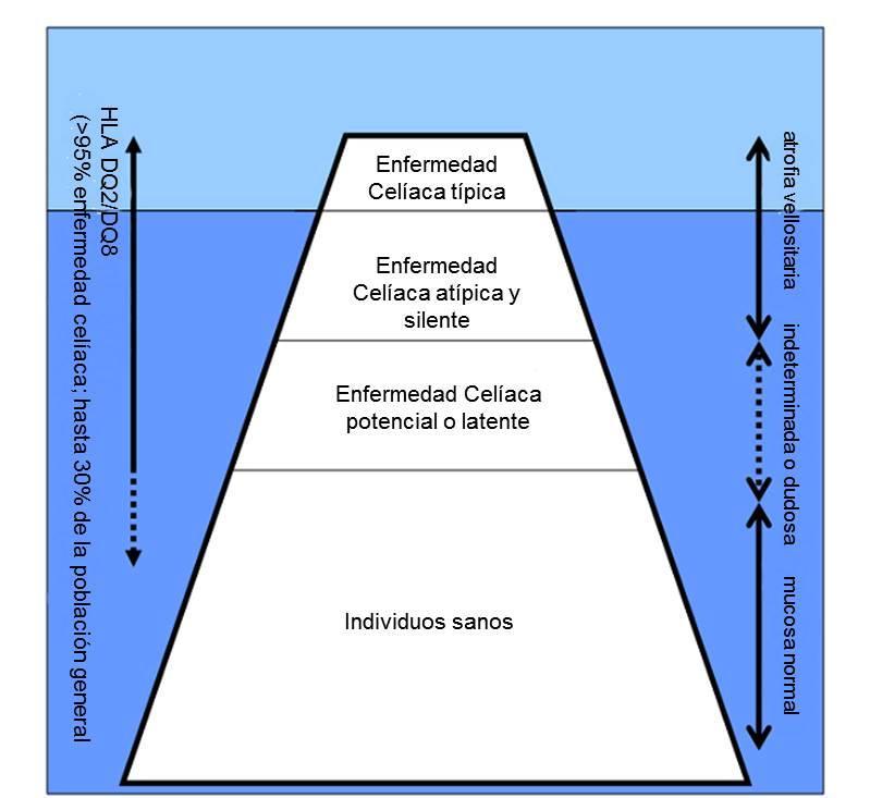 Enfermedad celíaca Figura 4. Iceberg de la enfermedad celíaca (modificado de Evans, K. E. & Sanders, D. S. Celiac disease. Gastroenterol Clin North Am 201:4; 639 50). 1.