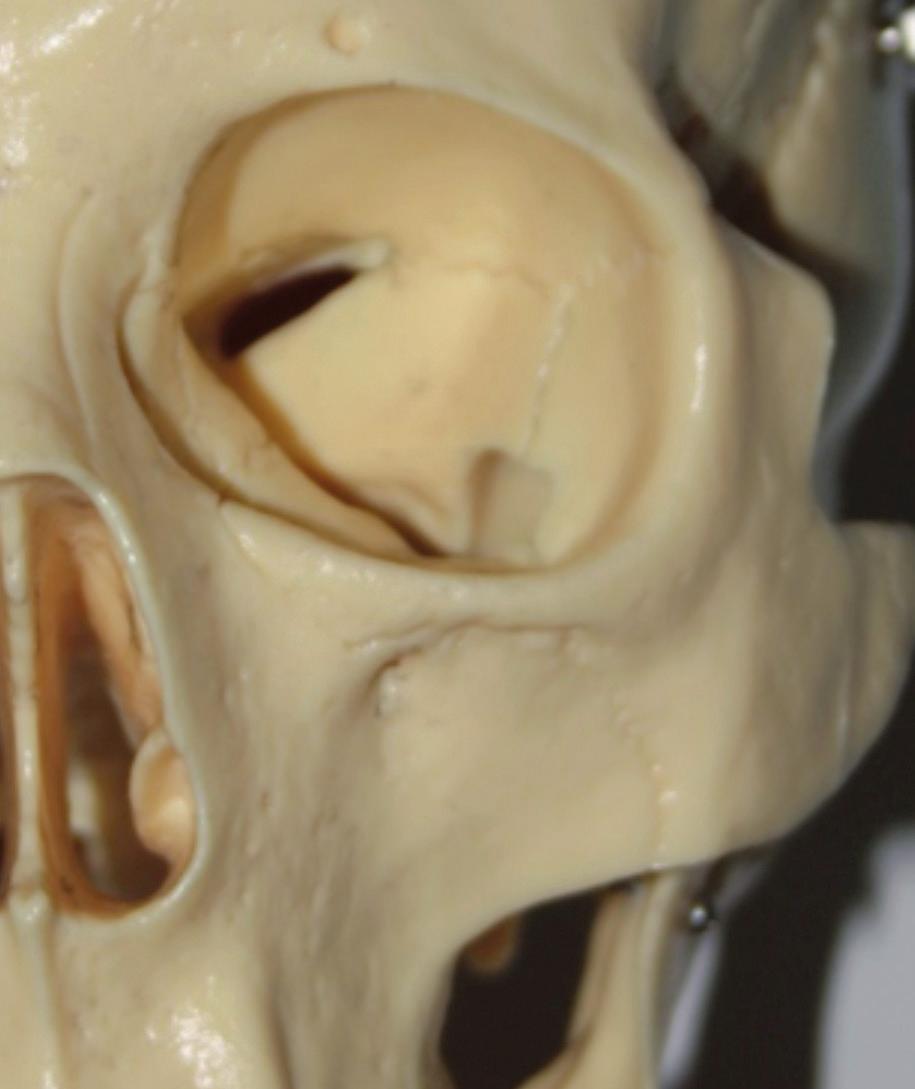 En la cara interna se exponen las crestas turbinales en las que se articulan los cornetes inferior y medio.