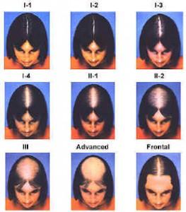 Página : 7 DE 7 ANEXO 2: Escala de Ludwig para Alopecia Androgénica.