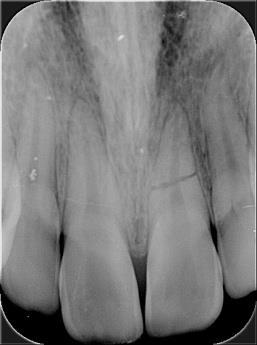 Extrusión del segmento coronal. Radiolucidez en la línea de la fractura. Signos de periodontitis apical o absceso asociado a la línea de fractura.