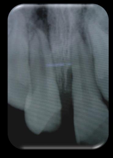 Se debe confirmar si todo el diente se ha extruido o si es únicamente fragmento coronal derivado de una fractura radicular.