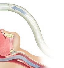 la garganta para mantener abierta la vía respiratoria. Hay diferentes tipos de CPAP.
