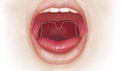 Procedimientos para la boca y el tejido de la garganta El objetivo de la mayoría de las cirugías es ampliar la vía respiratoria. En muchos casos, se recortan o se quitan los tejidos de la garganta.