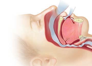 El ronquido se produce debido a la vibración de los tejidos de la garganta en una vía respiratoria estrecha.
