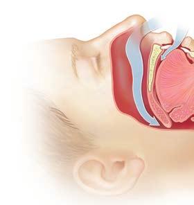 Un tabique nasal torcido (desviado) o cornetes nasales inflamados pueden empeorar los ronquidos y contribuir a la apnea.