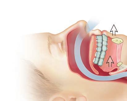Dispositivos orales En algunos casos, es posible que se utilice un dispositivo oral especial que ayude a disminuir o aliviar los ronquidos y la apnea del sueño.