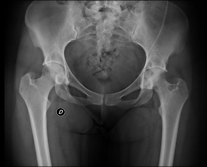 Caso Mujer de 29 años Consulta por dolor en la ingle izquierda que irradia hasta la rodilla por parte lateral y anterior del muslo izquierdo, de