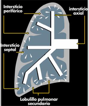 Evaluación del intersticio pulmonar Axial Peribroncovascular Centrolobulillar Periférico Subpleural Incluye