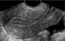 La THMcc causa un endometrio hipotrófico, delgado en la ultrasonografía (Fig1.A).