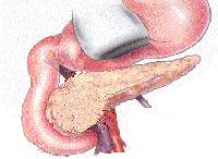 esplenectomia Pancreatectomia total Pancreatectomia cefàlica preservació duodenal Honjo (1950), Dagradi