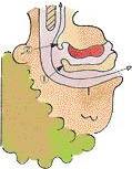 campanilla y la epiglotis que son pequeñas barreras que bloquean el conducto del