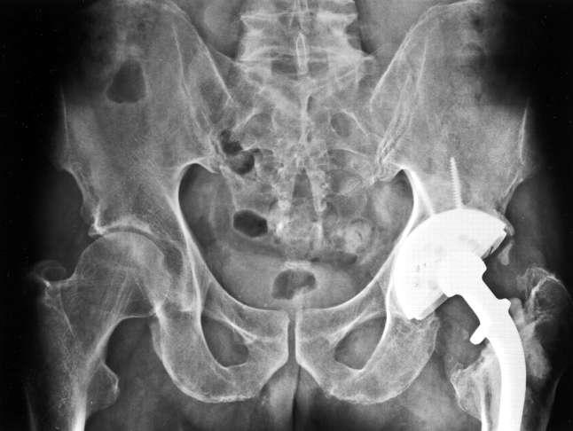 implantes COPA JUMBO 95% éxito a 10 años Dearborn JT, Harris WH. Acetabular revision arthroplasty using so- called jumbo cementless components: an average 7-year follow-up study.