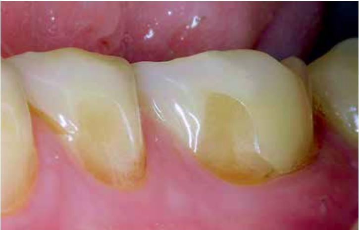 Fuente: Ganss C, Lussi A. Diagnosis of erosive tooth wear. Monogr Oral Sci. 2014;25:22-31. (13) Figura N 5. Desgaste erosivo facial El desgaste erosivo facial del diente.