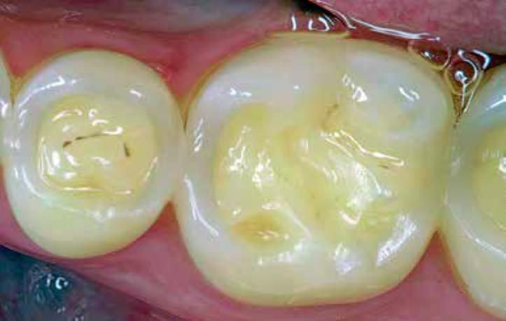 2014;25:22-31. (13) Figura N 8. Desgaste erosivo oclusal Drenaje oclusal de los dientes. Edad del paciente: 29 años (mismo paciente que en la figura 4).