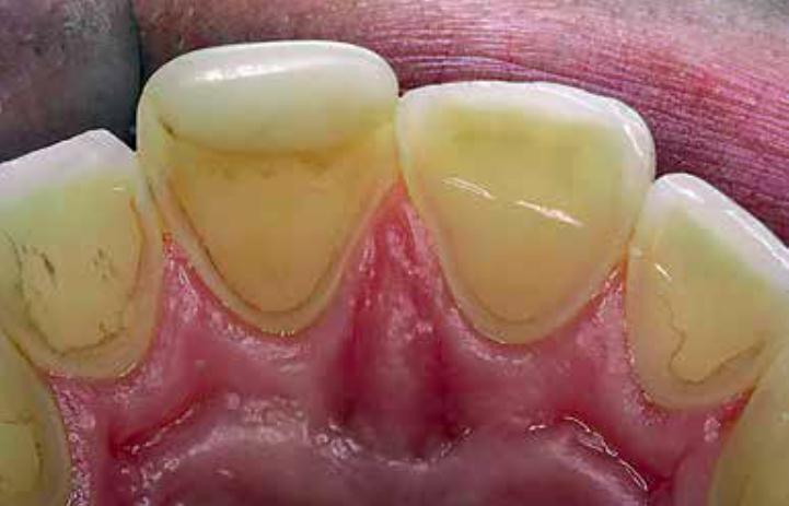 Figura N 11 Desgaste erosivo palatal Desgaste erosivo severo de los dientes. Observe el esmalte intacto a lo largo del margen gingival.