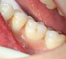 Grandio SO en su aplicación Los dentistas que han probado de viscosidad media lo estiman muy positivo; especialmente en cavidades pequeñas de las clase I y II, como material de