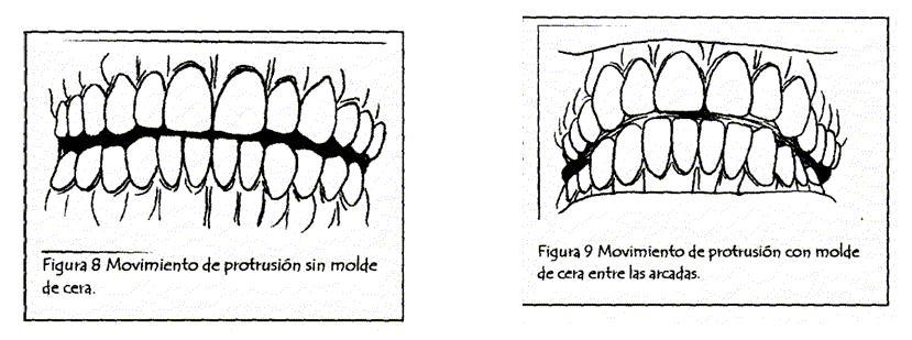 Toma de Registro Protrusivo: Ordene al paciente que se mire al espejo y mueva el maxilar inferior 3 o 4 mm hacia delante y hacia debajo de la relación céntrica, luego introduzca el molde de cera,