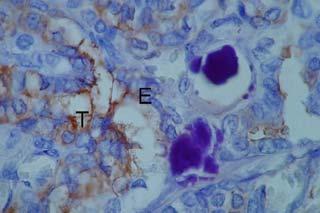 hiodes ni adenopatías en las cadenas cervicales y se observó una glándula tiroides de forma y densidad normal (figura 2). Fig. 1a. Carcinoma papilar en quiste del conducto tirogloso. a. Microfotografía 10X, tinción con hematoxilina eosina.