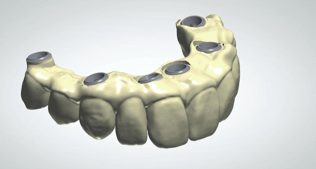 Curso orientado a odontólogos que quieran conocer el flujo de trabajo digital en implantología oral,