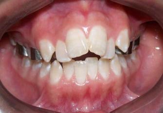 mandibular, labio superior en posición normal, labio inferior ligeramente retruído y hipertrofia de