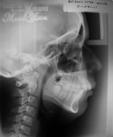 borla del mentón con alteración de la fonación Figura 7 Análisis Cefalométrico: Paciente con relación esquelética clase II con retrusión mandibular, crecimiento horario, Incisivos superiores
