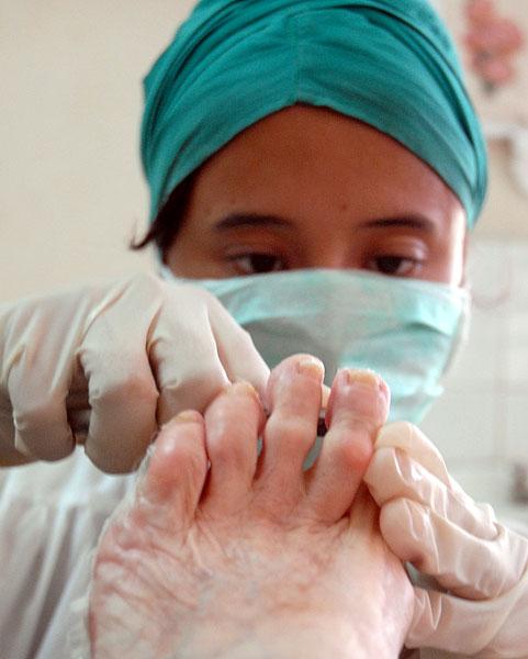El tratamiento con heberprot P ha librado a miles de pacientes cubanos e internacionales de