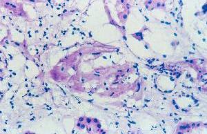 glomérulo esclerosado y atrofia tubular. Fig. 4.
