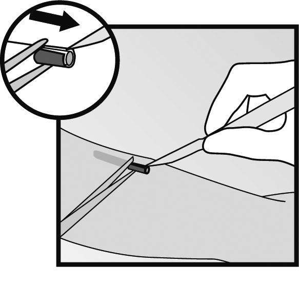 Figura 14 Figura 13 Si la punta del implante no se hace visible tras la incisión, inserte suavemente una pinza en la incisión (Figura 15). Gire la pinza hacia su otra mano (Figura 16).