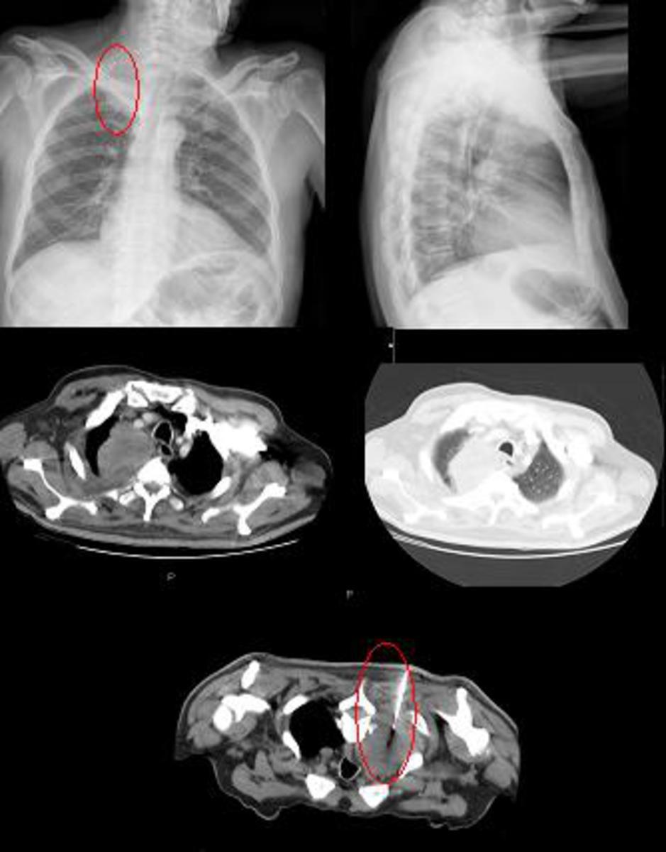 Fig. 4: Rx de tórax PA y L, TC de tórax y biopsia