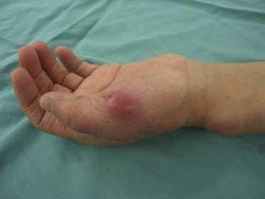 MYCOBACTERIUM ABSCESSUS Mycobacterium abscessus infection complicating hand rejuvenation with