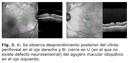 En el posoperatorio inmediato se precisa en SD-OCT desprendimiento posterior del vítreo perifoveal en el ojo derecho (Fig.