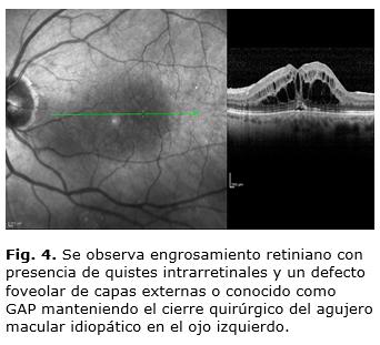 al mes y a los tres meses, con igual comportamiento en ambos ojos. A los cinco meses posterior a la cirugía, la paciente acude nuevamente y refiere disminución de la visión central en el OI.