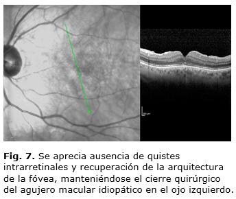 DISCUSIÓN El agujero macular idiopático es una causa frecuente de pérdida visual y consiste en una alteración macular que varía desde una alteración mínima en la interfaz vitreorretinal, hasta un