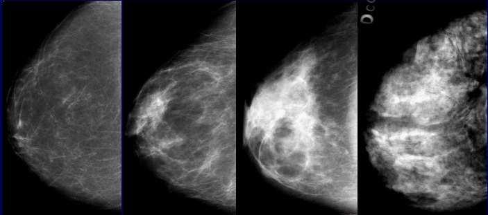 El sistema BIRADS: El American College of Radiology, en 1992, desarrolló el BI-RADS (Breast Imaging Reporting and Data System: Sistema de informes y registro de datos de imagen de la Mama), que se ha