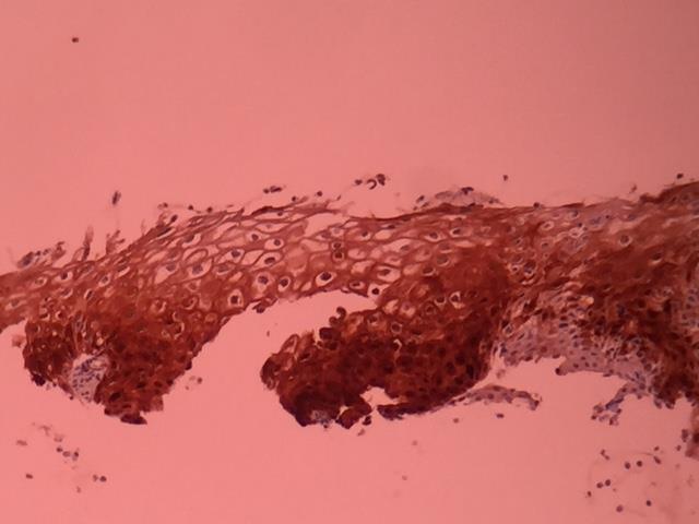 La interpretación de los portaobjetos con la tinción para la P16 INK4a mediante el uso de V-Kit CINTEC Histology debe realizarse en conjunción con portaobjetos con tinción de hematoxilina eosina,