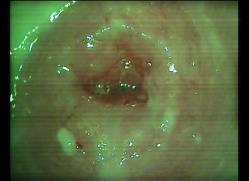 ANEXOS Colposcopia normal: A B C D E F Imagen 29.