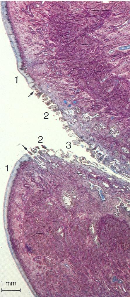 INTRODUCCIÓN Y PATOGÉNESIS 1: Epitelio pavimentoso, escamoso, pluriestratificado. 2: Mucosa glandular, con epitelio cilíndrico, monoestratificado.