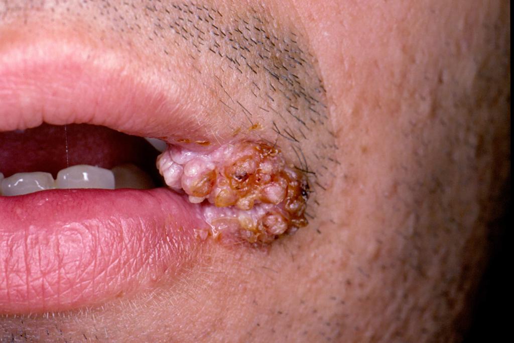 Infección oral por VPH