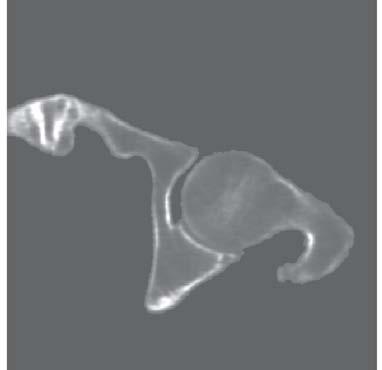 Fundamentos 3 Imágenes Biomédicas 63 Figura 3-13 Tomografía procesada de la cadera del paciente Debido a la gran cantidad de información que conlleva procesar imágenes de 512 x 512 píxeles en escala